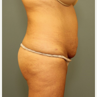 45-54 year old woman requesting a Tummy Tuck before 3346548