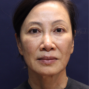 65-74 year old woman treated with Injectable Fillers after 3176443