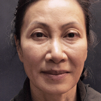 65-74 year old woman treated with Injectable Fillers before 3176443