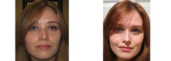 Mole Removal photos before 951892