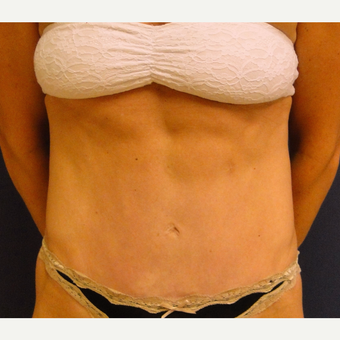 35-44 year old woman treated with Tummy Tuck after 3240161