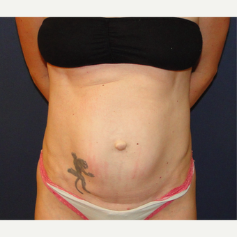35-44 year old woman treated with Tummy Tuck before 3240161