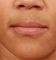 Juvederm - before and after before 1056240
