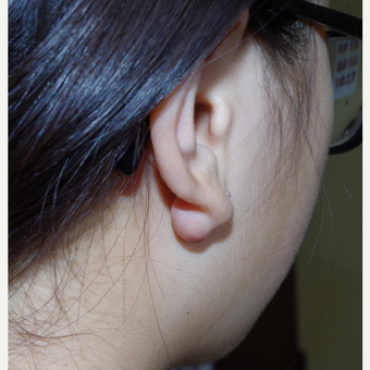 17 or under year old female treated with Ear Lobe Surgery before 3741892