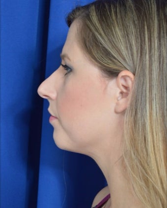25-34 year old woman treated with Rhinoplasty in New Orleans before 3271506