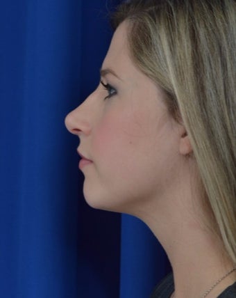 25-34 year old woman treated with Rhinoplasty in New Orleans after 3271506