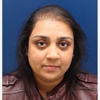 40 year old woman treated with NeoGraft before 2838129