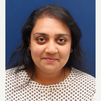 40 year old woman treated with NeoGraft after 2838129