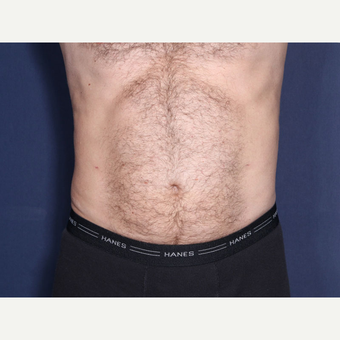 45-54 year old man treated with Liposuction (view 1 of 2) after 3709685
