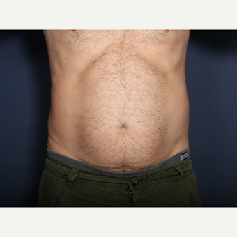 45-54 year old man treated with Liposuction (view 1 of 2) before 3709685