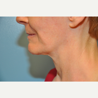 65-74 year old woman treated with ThermiTight Neck before 3075728