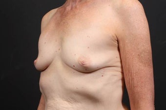 This patient underwent a breast augmentation 942996
