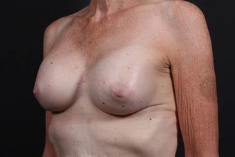 This patient underwent a breast augmentation 942996