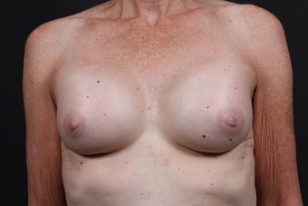 This patient underwent a breast augmentation after 942996