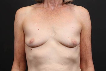 This patient underwent a breast augmentation before 942996