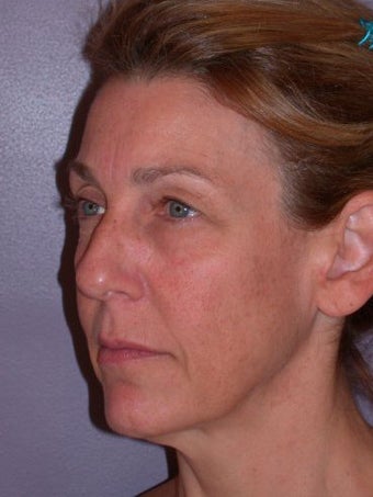 Eyelid Surgery before 280407
