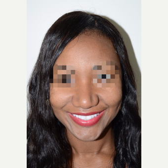 25-34 year old woman treated with Rhinoplasty after 3343808