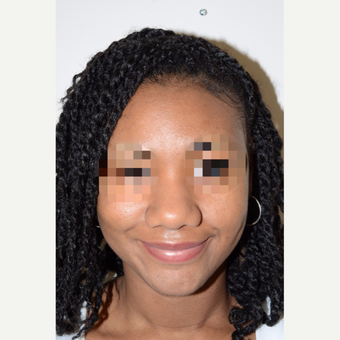 25-34 year old woman treated with Rhinoplasty before 3343808