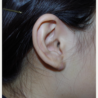 17 or under year old female treated with Ear Lobe Surgery after 3741885