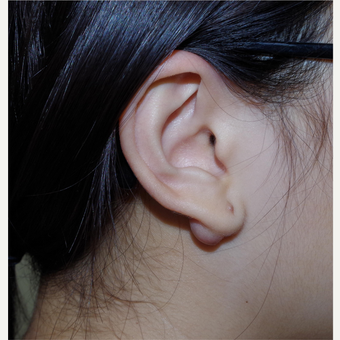 17 or under year old female treated with Ear Lobe Surgery before 3741885