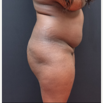 25-34 year old woman treated with Brazilian Butt Lift before 3363812
