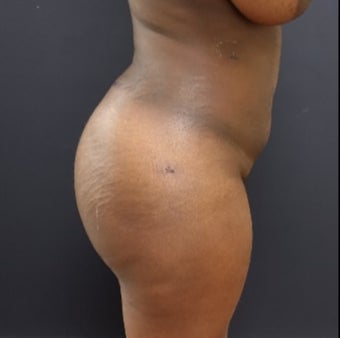 25-34 year old woman treated with Brazilian Butt Lift after 3363812