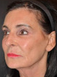 65 year old white female following 3 sessions of Sculptra for facial skin tightening 1427597