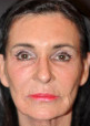 65 year old white female following 3 sessions of Sculptra for facial skin tightening before 1427597