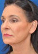 65 year old white female following 3 sessions of Sculptra for facial skin tightening 1427597