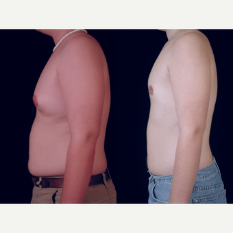 25-34 year old man treated with Liposuction before 3659112