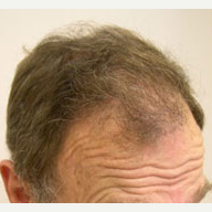 65 year old man treated with FUE Hair Transplant after 3839152