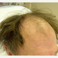 65 year old man treated with FUE Hair Transplant before 3839152