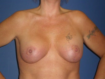 Breast Lift with Implants after 1326369