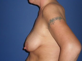 Breast Lift with Implants 1326369