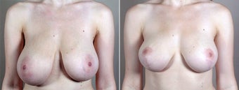 22 Year Old Female Treated for Large Asymmetric Breasts before 1520580