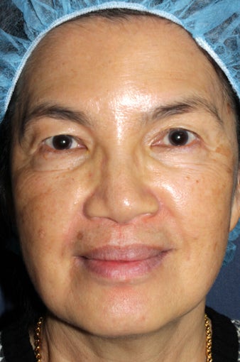 63 year old Asian female with brown spots and sun damage with Fraxel Dual and Alex laser before 752083