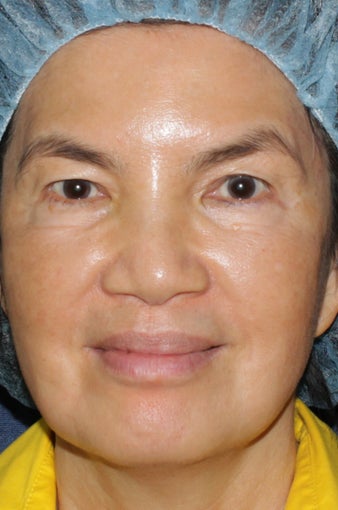 63 year old Asian female with brown spots and sun damage with Fraxel Dual and Alex laser after 752083