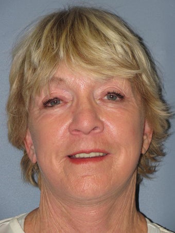 Chemical Peel - Blue Peel after 956795
