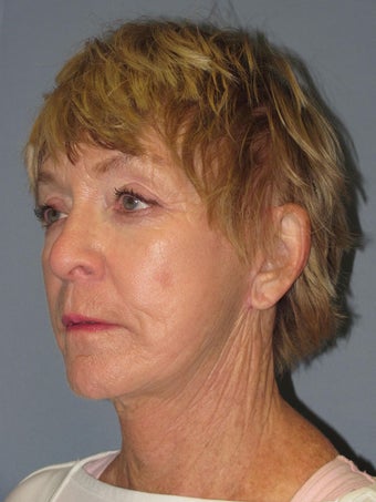 Chemical Peel - Blue Peel 956795