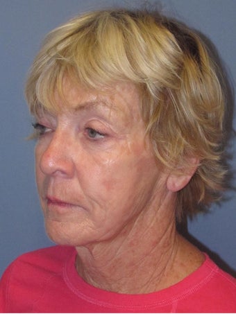 Chemical Peel - Blue Peel 956795