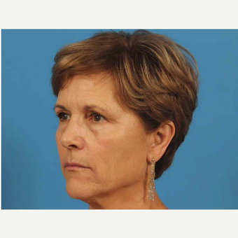 55-64 year old woman treated with Upper Eyelid Surgery before 3787487