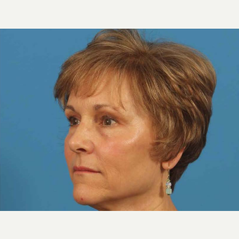 55-64 year old woman treated with Upper Eyelid Surgery after 3787487