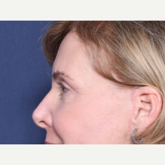 55-64 year old woman treated with Eyelid Surgery (view 2 of 2) after 3180969