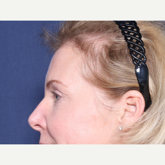 55-64 year old woman treated with Eyelid Surgery (view 2 of 2) before 3180969