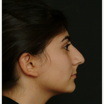 17 or under year old woman treated with Rhinoplasty before 3582831