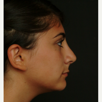 17 or under year old woman treated with Rhinoplasty after 3582831