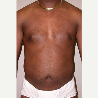 35-44 year old male treated with SAFELipo before 3126014