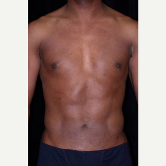 35-44 year old male treated with SAFELipo after 3126014