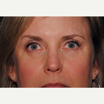 45-54 year old woman treated with Eyelid Surgery after 3439822