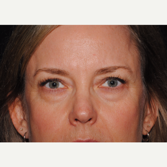 45-54 year old woman treated with Eyelid Surgery before 3439822